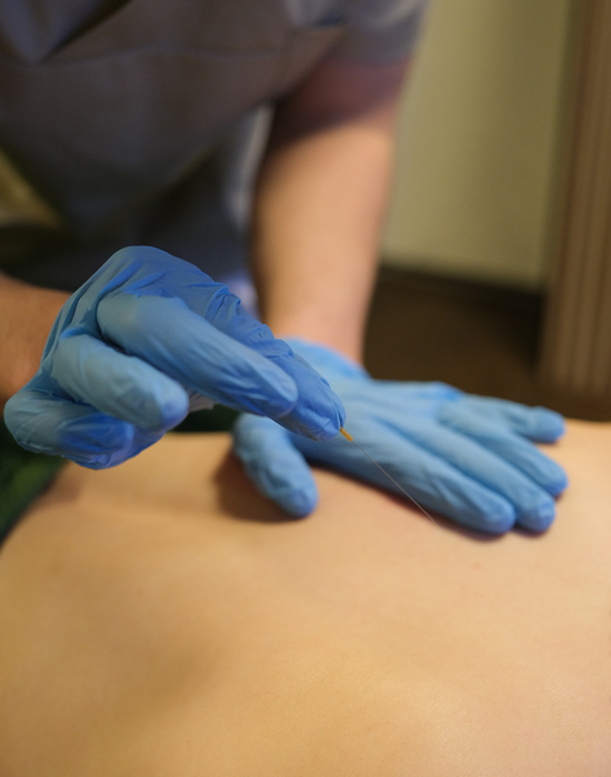 Dry Needling